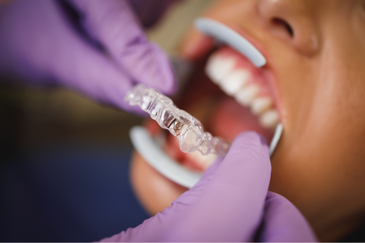 The best Invisalign providers in Canberra