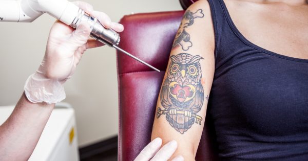 The best tattoo removalists in Canberra