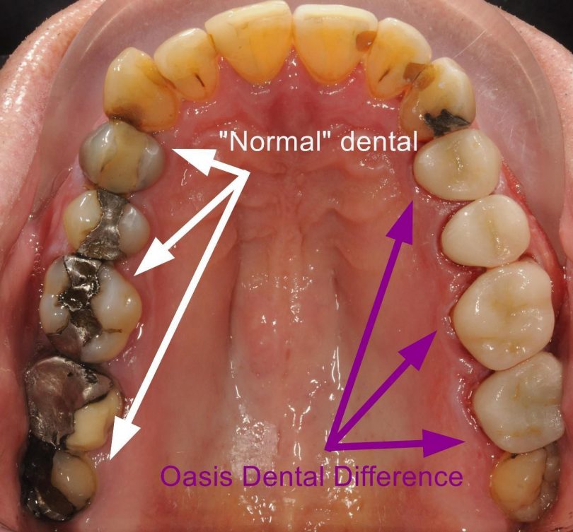 Comparison of tooth fillings and tooth restoration