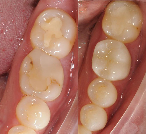 Tooth filling comparison with a tooth restoration